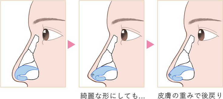 綺麗な形にしても…皮膚の重みで逆戻り