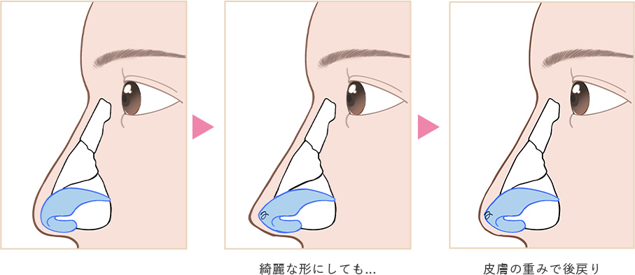 綺麗な形にしても…皮膚の重みで逆戻り