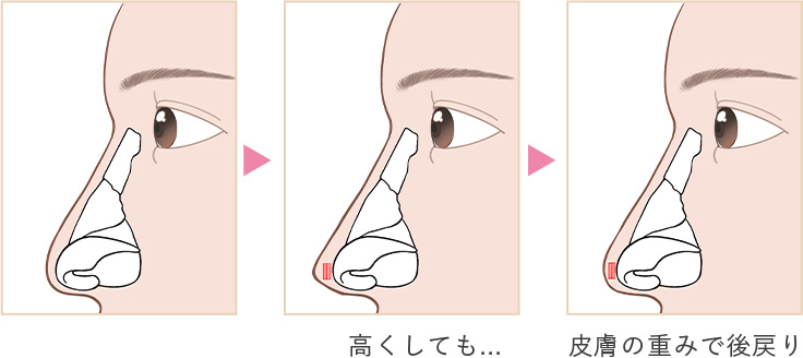 綺麗な形にしても…皮膚の重みで逆戻り