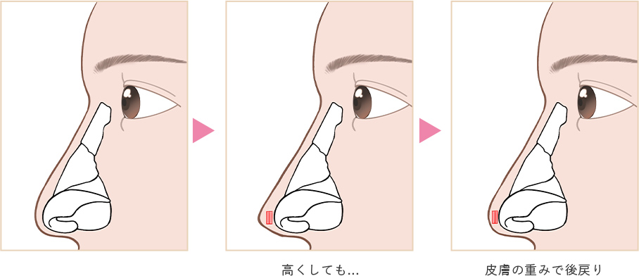 綺麗な形にしても…皮膚の重みで逆戻り