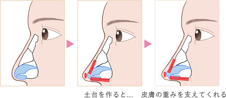 綺麗な形にしても…皮膚の重みで逆戻り