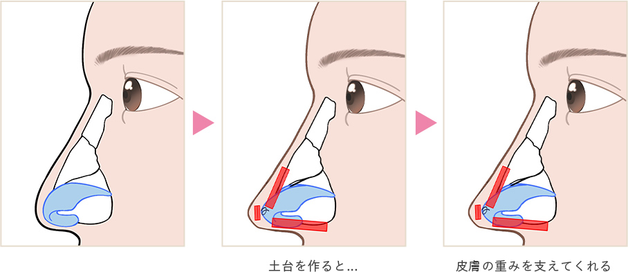 綺麗な形にしても…皮膚の重みで逆戻り