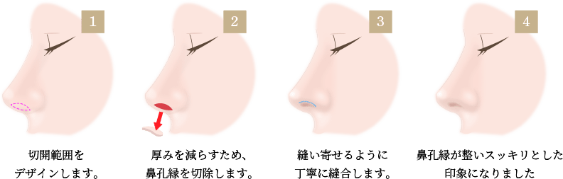 鼻孔縁挙上術の画像