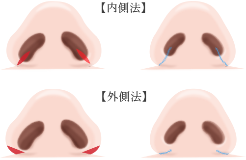 鼻翼縮小術の画像