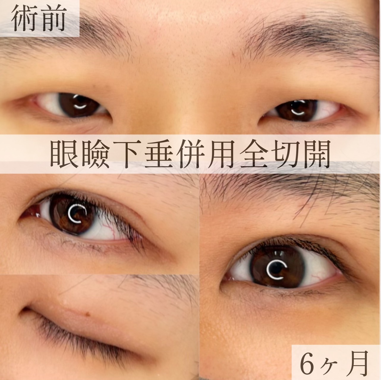 眼瞼下垂併用全切開1ヶ月～6ヶ月の画像